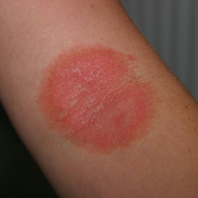 Formation continue et Informations en Dermatologie Vétérinaire Dermatophytosis transmitted from a pet to a human